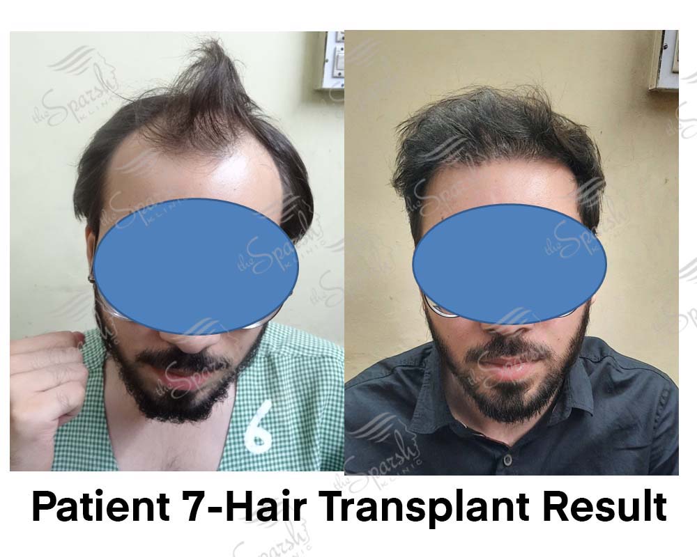 Real Sparsh Klinic hair transplant result, patient 7, face blurred for privacy