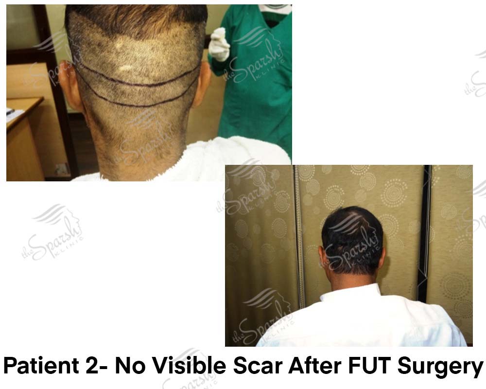 Real Sparsh Klinic FUT hair transplant, no visible scar, patient 2, face blurred for privacy