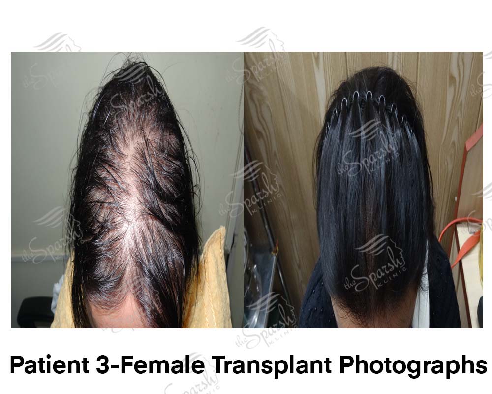 Real Sparsh Klinic female hair transplant result, patient 3, face blurred for privacy