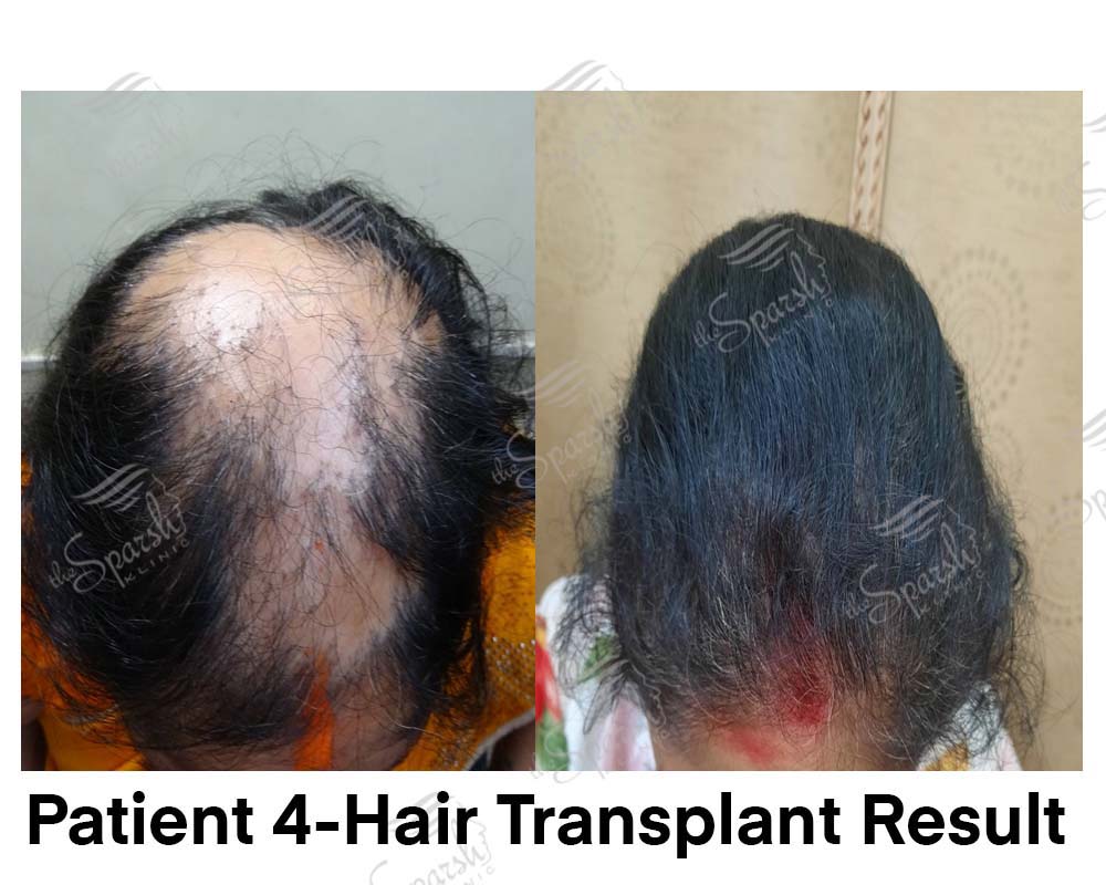 Real Sparsh Klinic hair transplant result, patient 4, face blurred for privacy