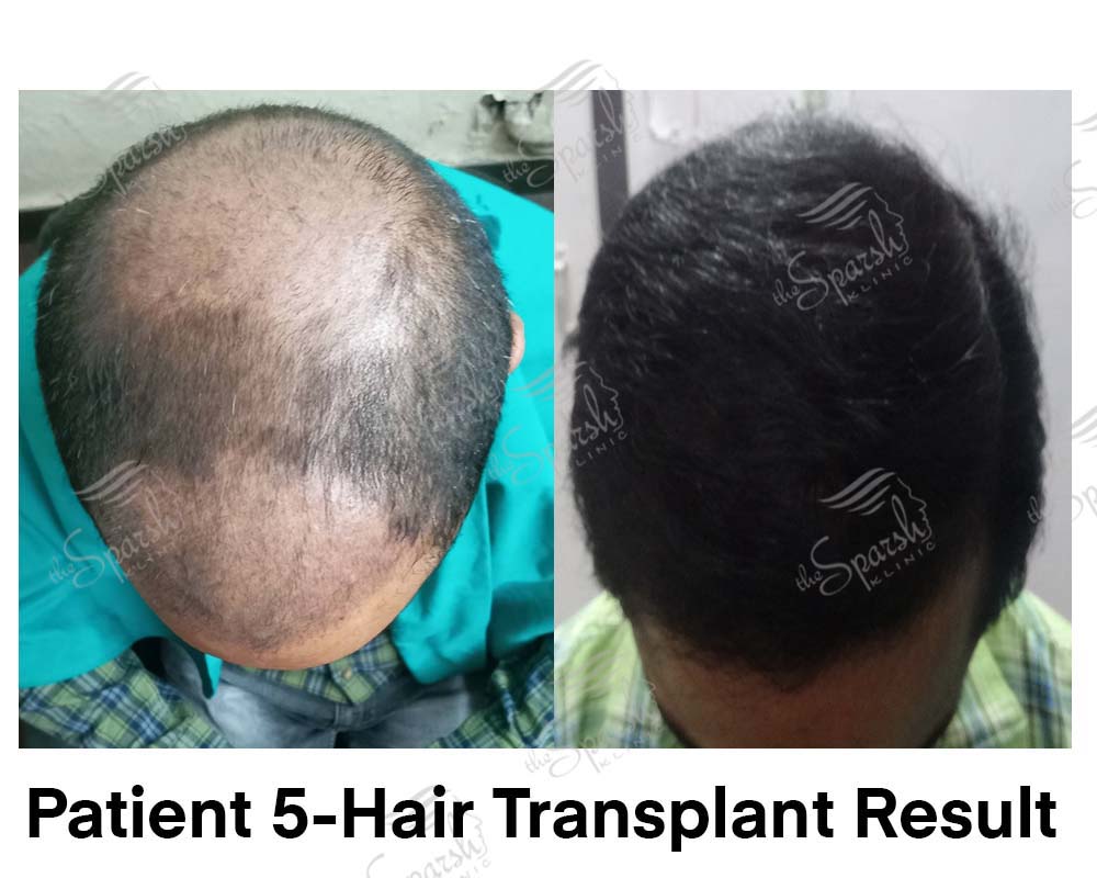 Real Sparsh Klinic hair transplant result, patient 5, face blurred for privacy