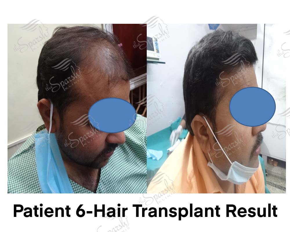 Real Sparsh Klinic hair transplant result, patient 6, face blurred for privacy