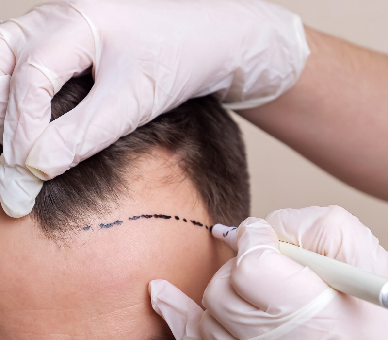 Sparsh Klinic pre-procedure hairline marking